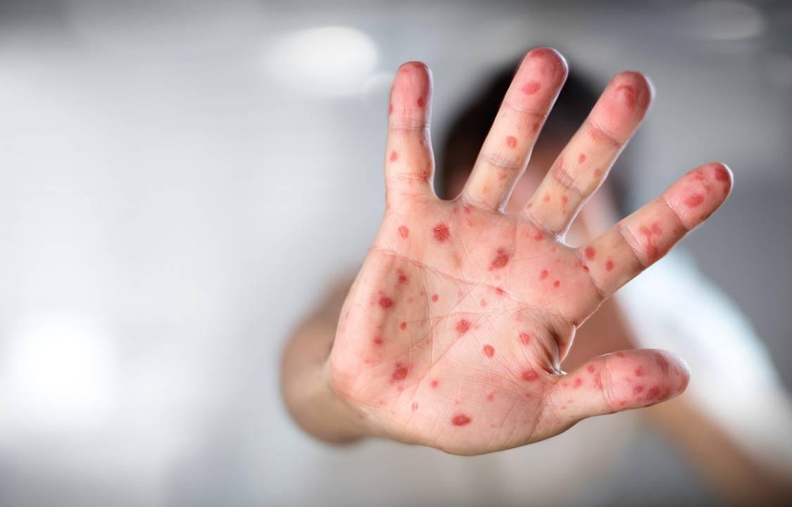 Campanha contra o sarampo prioriza profissionais com maior risco de exposição