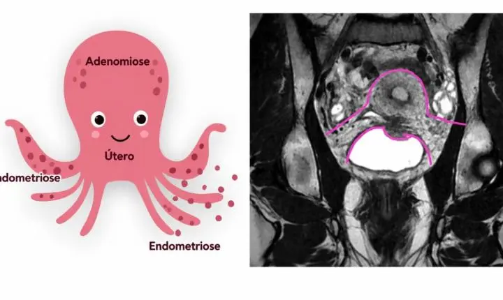 Gravidez não cura a endometriose; entenda por que os sintomas podem melhorar
